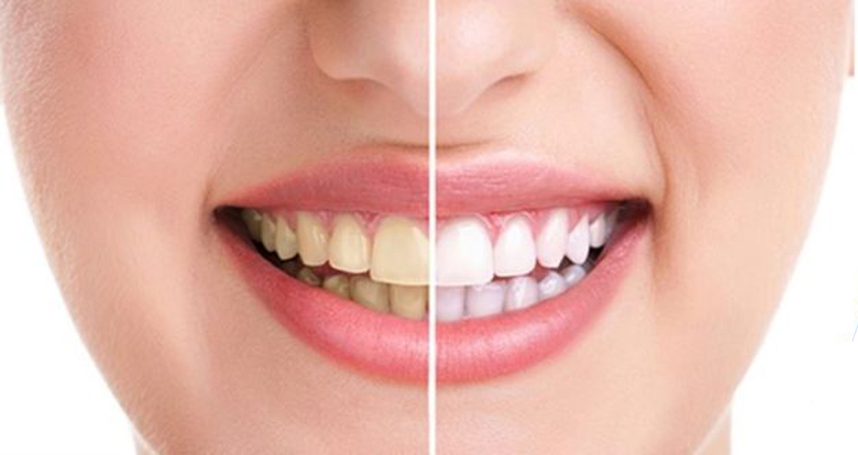 Ultrasonic Teeth Whitening